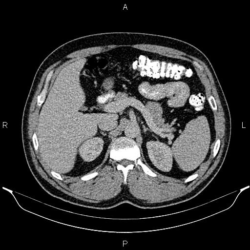 Acute appendicitis (Radiopaedia 84780-100240 Axial C+ portal venous phase 31).jpg