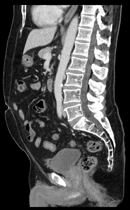 Acute appendicitis - large appendicoliths (Radiopaedia 61805-69820 Sagittal C+ portal venous phase 57).jpg