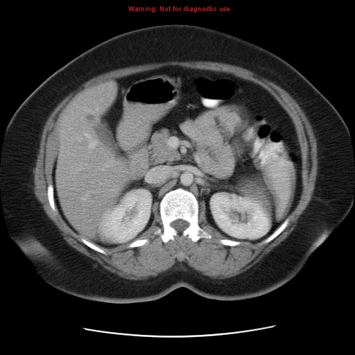 File:Acute appendicitis complicated by ovarian vein thrombophlebitis (Radiopaedia 16172-15851 Axial C+ portal venous phase 36).jpg