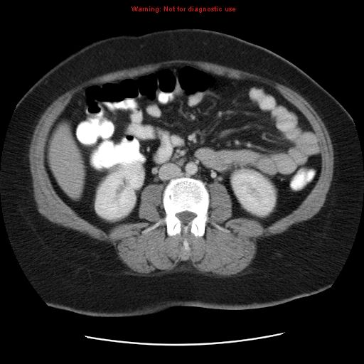 Acute appendicitis complicated by ovarian vein thrombophlebitis (Radiopaedia 16172-15851 Axial C+ portal venous phase 49).jpg