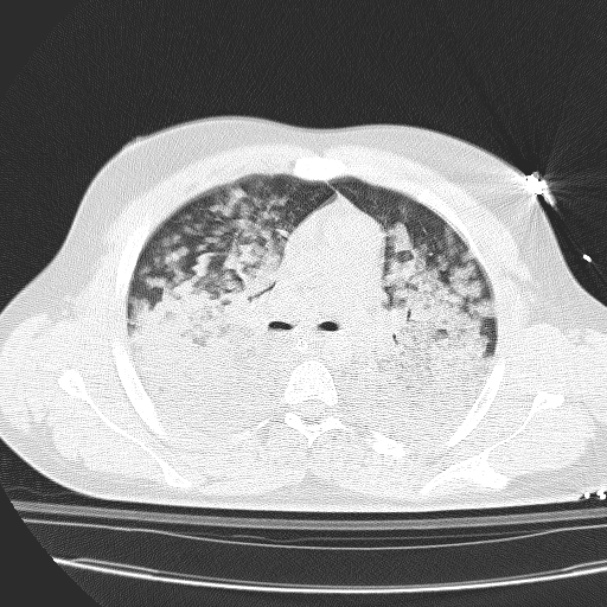 Acute aspiration pneumonitis (Radiopaedia 33605-34703 Axial lung window 41).jpg