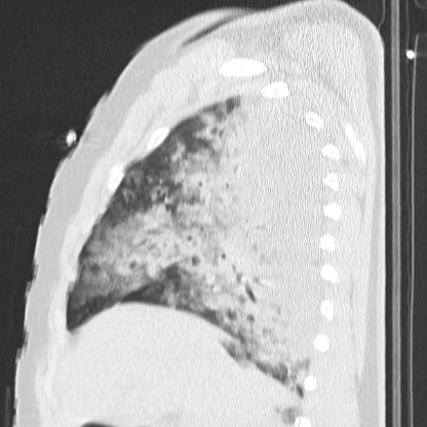 Acute aspiration pneumonitis (Radiopaedia 33605-34703 Sagittal lung window 29).jpg