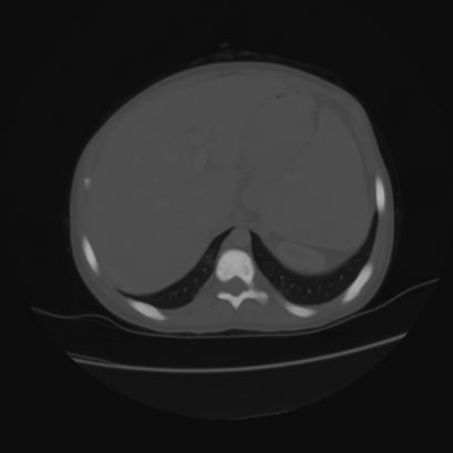 File:Acute calculous cholecystitis in patient with osteopetrosis (Radiopaedia 77871-90159 Axial bone window 10).jpg