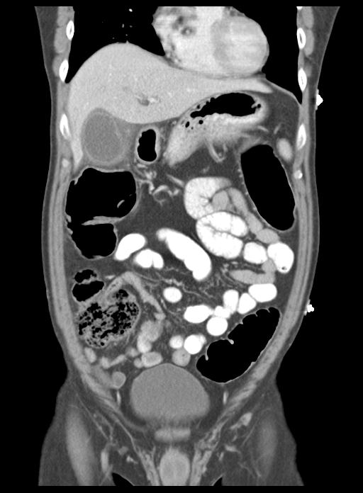 Acute cholecystitis (Radiopaedia 29814-30327 Coronal C+ portal venous phase 18).jpg