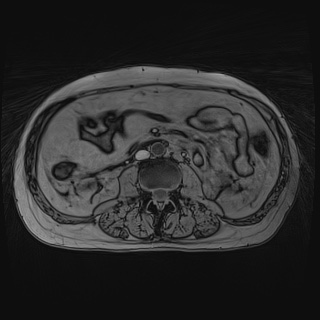 File:Acute cholecystitis (Radiopaedia 72392-82923 Axial T1 out-of-phase 80).jpg