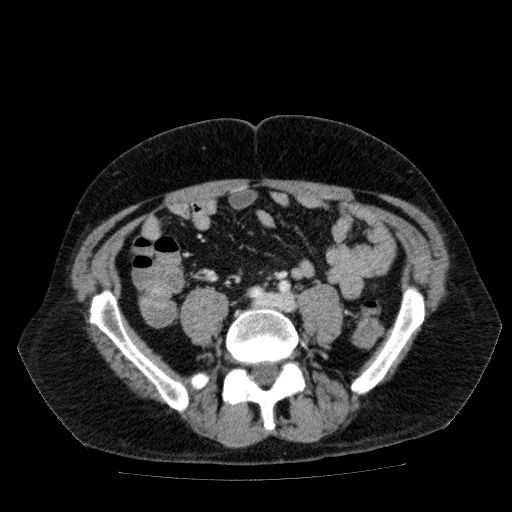 File:Acute cholecystitis and incidental left sided IVC (Radiopaedia 49352-54459 Axial C+ portal venous phase 102).jpg