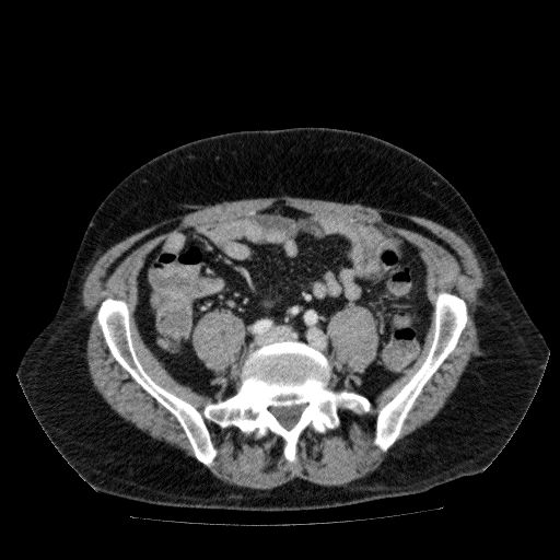 Acute cholecystitis and incidental left sided IVC (Radiopaedia 49352-54459 Axial C+ portal venous phase 106).jpg
