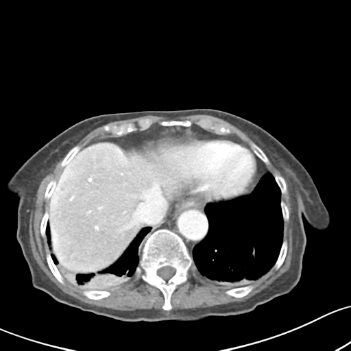 File:Acute cholecystitis with contained perforation (Radiopaedia 47328-51907 Axial C+ portal venous phase 10).png