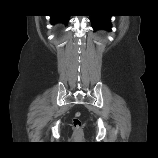 Acute cholecystitis with tensile fundus sign (Radiopaedia 71394-81723 Coronal non-contrast 96).jpg