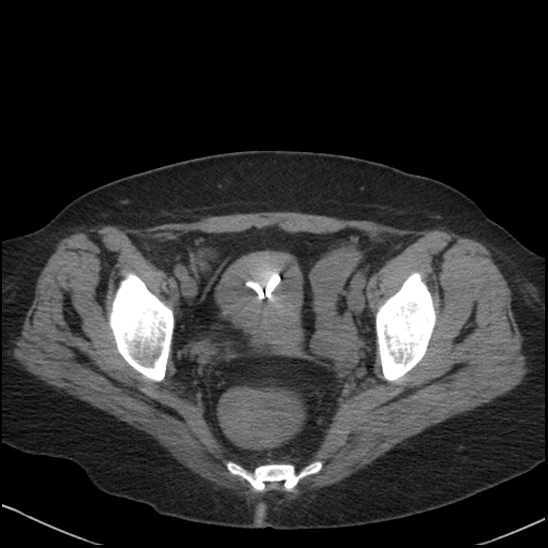 Acute colonic hemorrhage in ulcerative colitis (Radiopaedia 77415-89538 Axial non-contrast 119).jpg