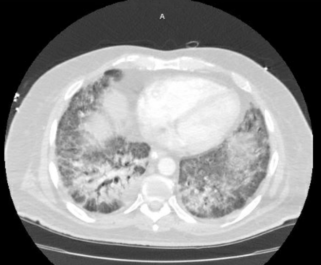 Acute cor pulmonale (ultrasound) (Radiopaedia 83508-98818 Axial lung window 62).jpg