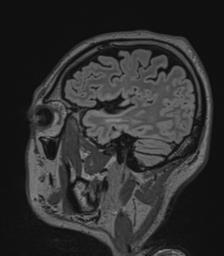 Acute disseminated encephalomyelitis (ADEM)- Anti-NMDA receptor encephalitis (Radiopaedia 54920-61201 Sagittal FLAIR 23).png