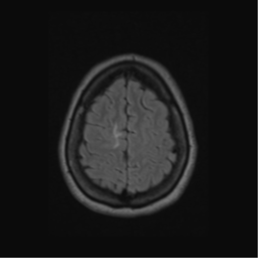 Acute disseminated encephalomyelitis (ADEM) (Radiopaedia 38073-40065 Axial FLAIR 56).png
