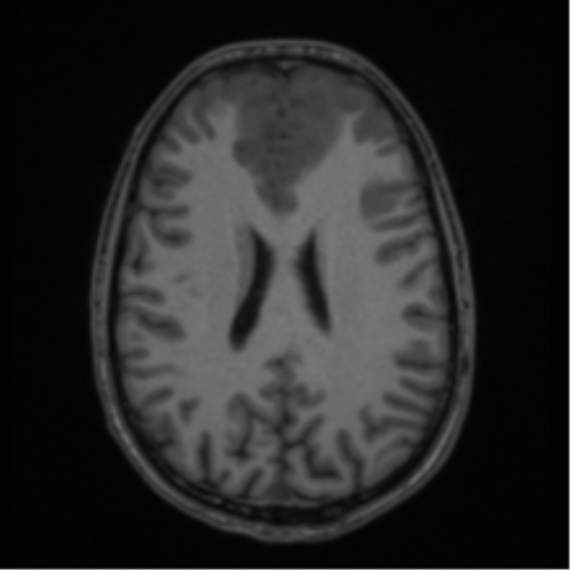 Acute disseminated encephalomyelitis (ADEM) (Radiopaedia 65319-74349 Axial T1 42).png