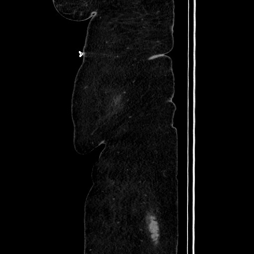 Acute diverticulitis - transverse colon (Radiopaedia 87063-103327 Sagittal C+ portal venous phase 37).jpg