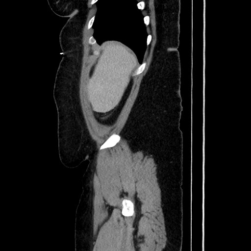 Acute diverticulitis - transverse colon (Radiopaedia 87063-103327 Sagittal C+ portal venous phase 55).jpg