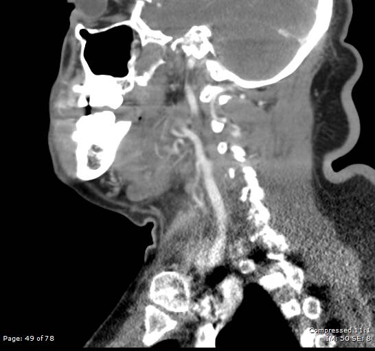 File:Acute epiglottitis (Radiopaedia 54375-60590 Sagittal 18).jpg