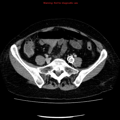 File:Acute gangrenous cholecystitis (Radiopaedia 10123-10661 Axial C+ portal venous phase 75).jpg