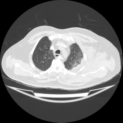 File:Acute heart failure (CT) (Radiopaedia 79835-93075 Axial lung window 10).png