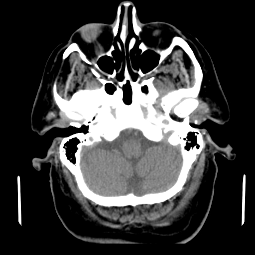 Acute hemorrhagic stroke (Radiopaedia 17507-17223 Axial non-contrast 10).jpg