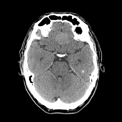 File:Acute hippocampal infarction (Radiopaedia 10610-11071 non-contrast 3).jpg