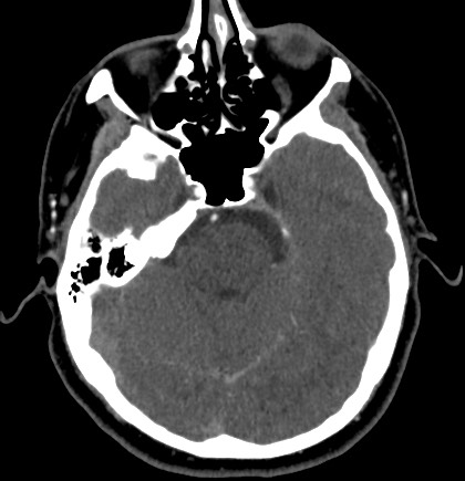 Acute internal carotid artery dissection (Radiopaedia 53541-59630 Axial C+ arterial phase 20).jpg