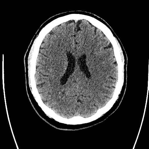 File:Acute left middle cerebral artery territory ischemic stroke (Radiopaedia 35688-37223 Axial non-contrast 51).png