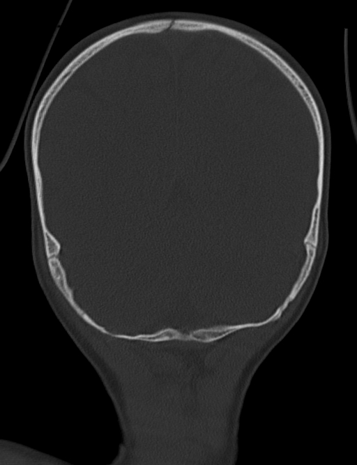 Acute mastoiditis (Radiopaedia 82678-96881 Coronal bone window 61).jpg
