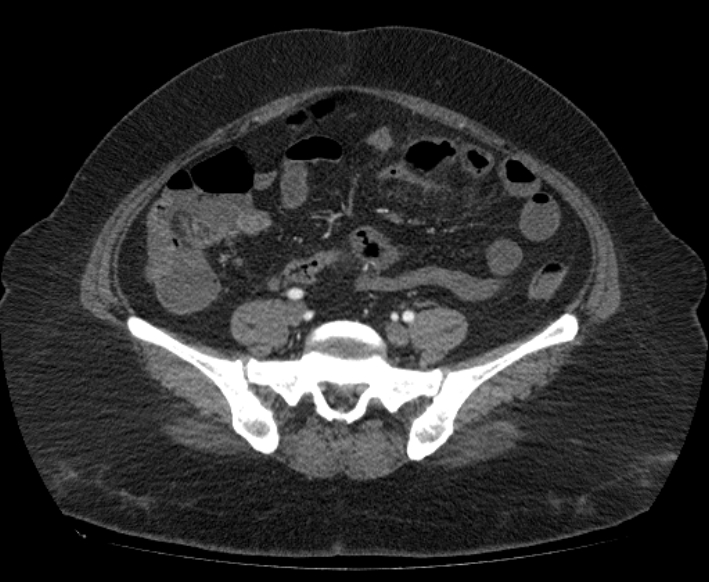 Acute mesenteric ischemia (Radiopaedia 80029-93316 Axial C+ arterial phase 92).jpg