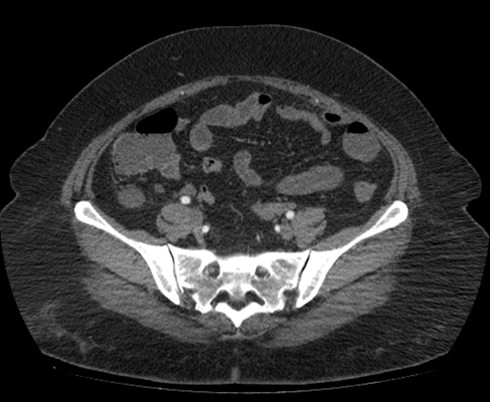 Acute mesenteric ischemia (Radiopaedia 80029-93316 Axial C+ arterial phase 99).jpg