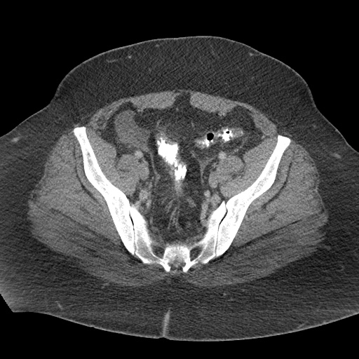Acute mesenteric venous ischemia (Radiopaedia 46041-50383 Axial C+ portal venous phase 116).jpg