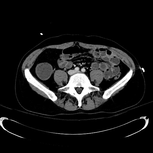 File:Acute myocardial infarction in CT (Radiopaedia 39947-42415 Axial C+ portal venous phase 84).jpg