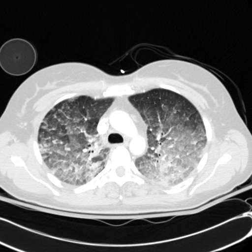 Acute myocardial infarction in CT (Radiopaedia 39947-42415 Axial lung window 37).jpg