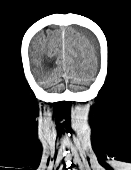 Acute on chronic subdural hematoma (Radiopaedia 74814-85823 Coronal non-contrast 56).jpg