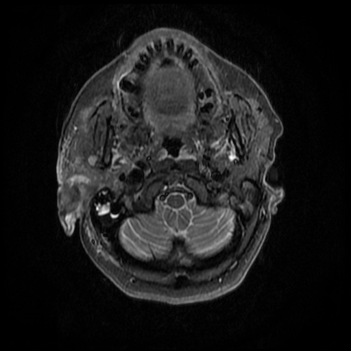 File:Acute otitis externa (Radiopaedia 57296-64236 Axial STIR 11).jpg