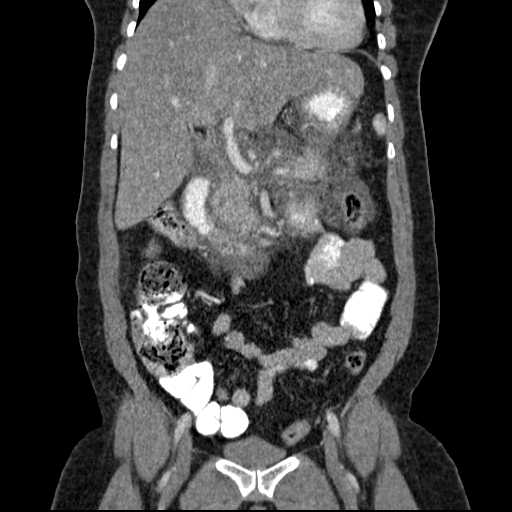 File:Acute pancreatitis (Radiopaedia 20829-20744 Coronal C+ portal venous phase 24).jpg