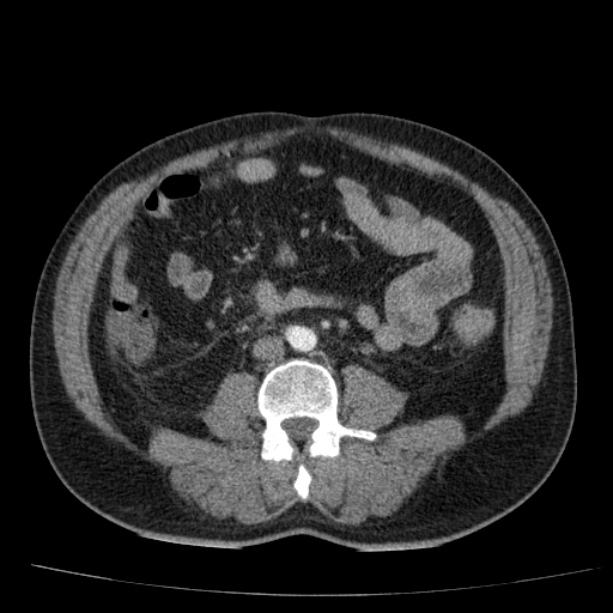 Acute pancreatitis (Radiopaedia 26663-26813 Axial C+ arterial phase 60).jpg