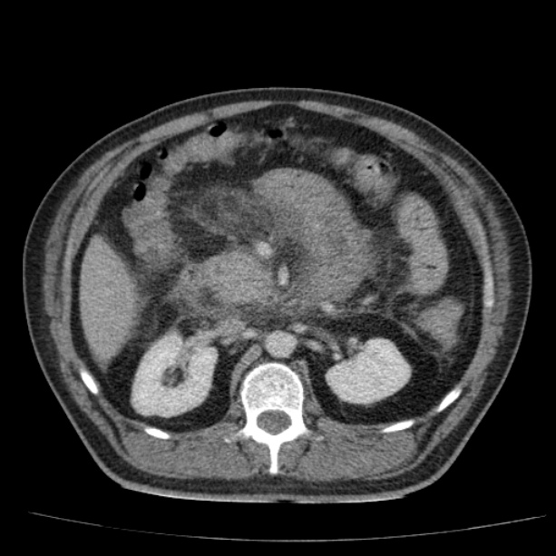 Acute pancreatitis (Radiopaedia 26663-26813 Axial C+ portal venous phase 34).jpg