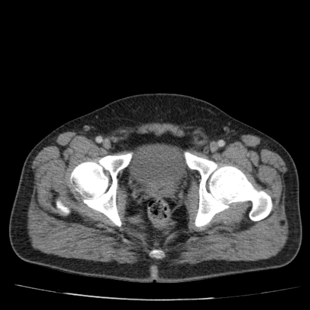 Acute pancreatitis (Radiopaedia 26663-26813 Axial C+ portal venous phase 84).jpg