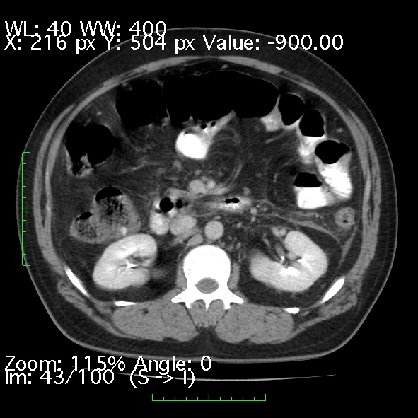Acute pancreatitis (Radiopaedia 34043-35276 Axial C+ portal venous phase 43).jpg