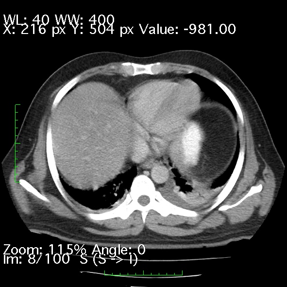 Acute pancreatitis (Radiopaedia 34043-35276 Axial C+ portal venous phase 8).jpg