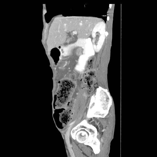 File:Acute pancreatitis (Radiopaedia 50213-55558 Sagittal C+ portal venous phase 12).jpg