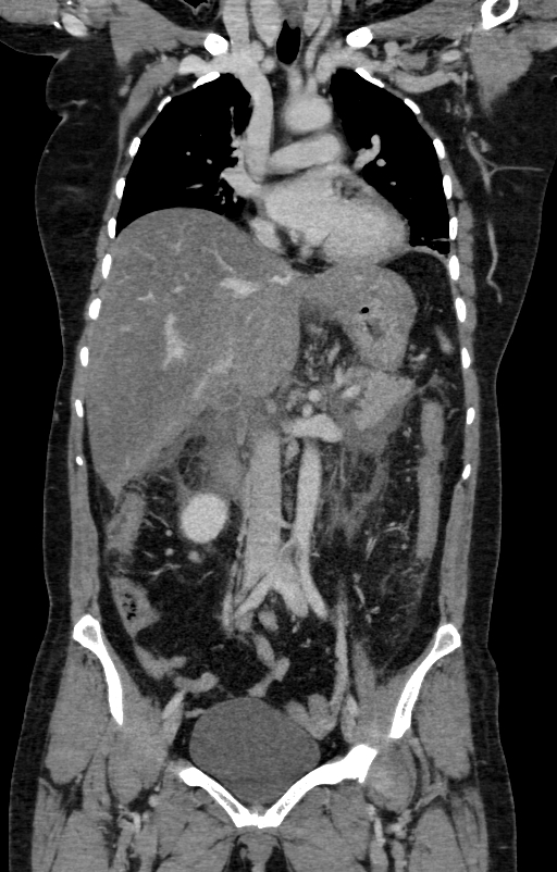 Acute pancreatitis (Radiopaedia 80007-93285 Coronal C+ portal venous phase 52).jpg