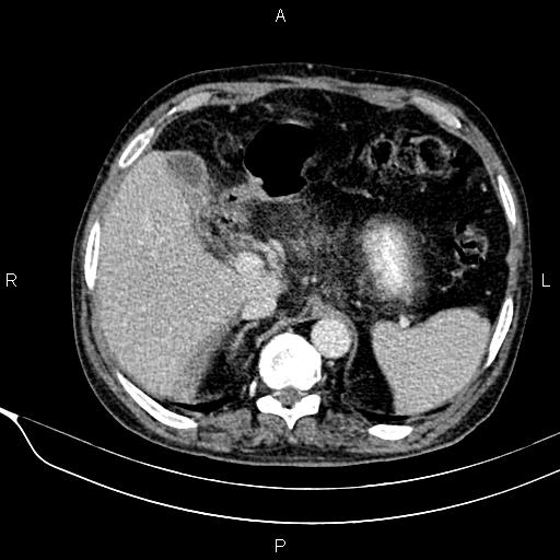 Acute pancreatitis (Radiopaedia 85146-100701 Axial C+ portal venous phase 20).jpg