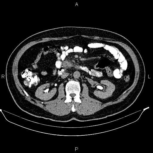 File:Acute pancreatitis (Radiopaedia 85390-101010 Axial C+ delayed 38).jpg
