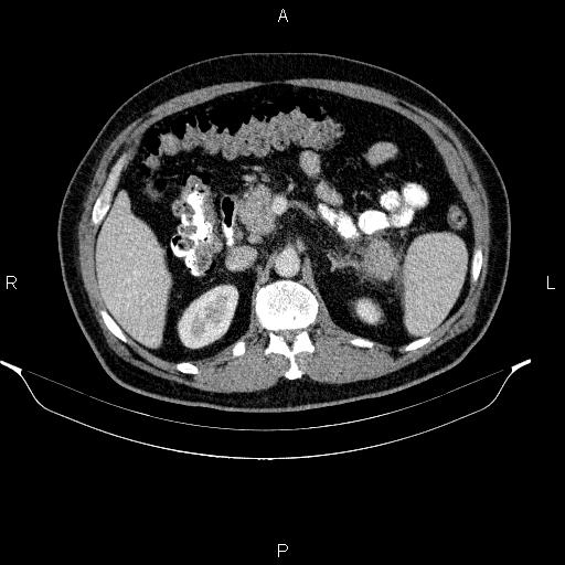 Acute pancreatitis (Radiopaedia 85390-101010 Axial C+ portal venous phase 37).jpg