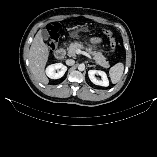 Acute pancreatitis (Radiopaedia 87428-103757 Axial C+ portal venous phase 37).jpg