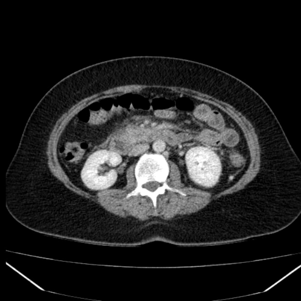 Acute pancreatitis - Balthazar C (Radiopaedia 26569-26714 Axial C+ portal venous phase 48).jpg