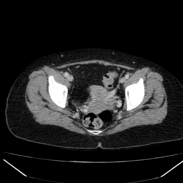 Acute pancreatitis - Balthazar C (Radiopaedia 26569-26714 Axial C+ portal venous phase 86).jpg