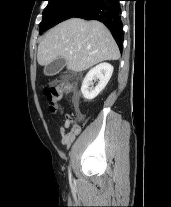 Acute pancreatitis - Balthazar E (Radiopaedia 23080-23110 Sagittal C+ portal venous phase 22).jpg